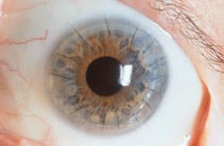 Corneal transplant