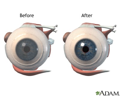 FuchsE28099 Dystrophy in Patients with Cataracts