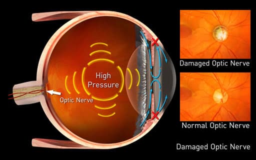 Glaucoma Center