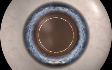 Laser Capsulorhexis