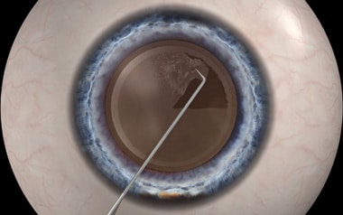 Manual Capsulorhexis