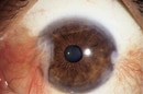 Pterygium