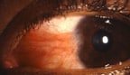 Symptoms of a Pterygium