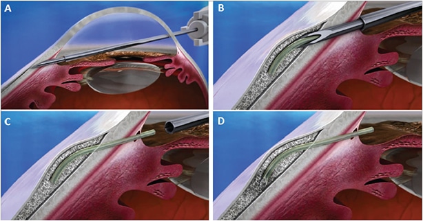 Xen Gel Stent