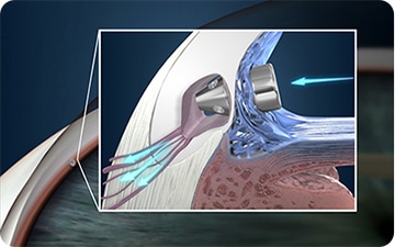 iStent inject Schlemm canal