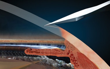 1765546413_Blade-Incisions Laser Cataract Surgery vs Traditional Cataract Surgery