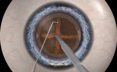 1765546429_Manual-Dissection Laser Cataract Surgery vs Traditional Cataract Surgery
