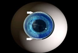 1765546513_LenSx-Femtosecond-Laser Cataract Care
