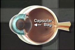 1765546921_capsular-bag-1 Posterior Capsulotomy