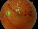 1765547053_Retinal-Vein-Occlusion Retinal Vein Occlusion