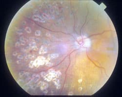 1765547073_Pan-Retinal-Photocoagulation Pan-Retinal Photocoagulation