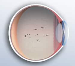 1765547152_Vitreous-Detachment Flashes & Floaters